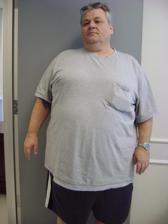 Gastric Bypass before 216849