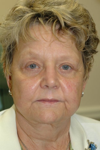 Bilateral upper and lower eyelid surgery after 341554