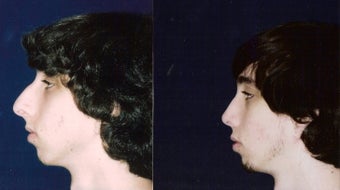 Rhinoplasty and Septoplasty after 241678