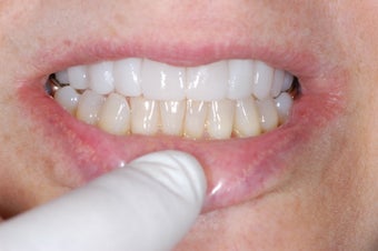 Lumineers Dental Veneers after 382135