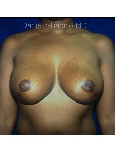 Bilateral Breast Reduction after 250001