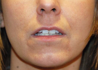 Lip Augmentation before 199328