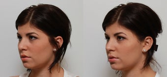Non Surgical Nose Job Rhinoplasty 553496