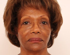 Sculptra Injection: 3 Vials to Midface and Jowls before 376677