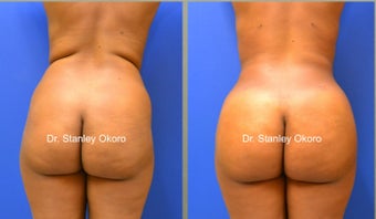 Brazilian Buttock Lift before 567084