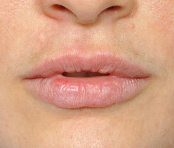 Lip Augmentation before 536185