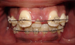 Braces and Extraction before 349089