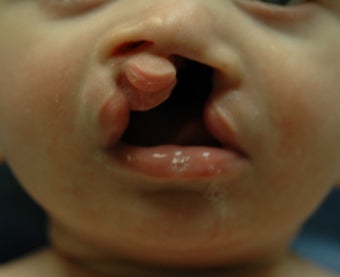 Cleft lip and palate before 594506