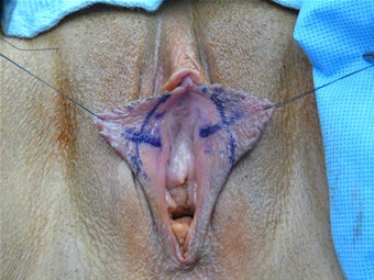 Labia Reduction Surgery before 100695