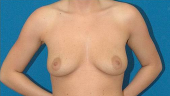 Breast Augmentation before 600680