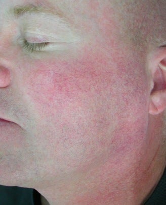 Facial Vein Treatment after 374356
