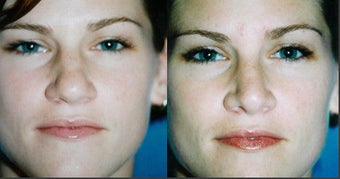 Rhinoplasty before 565872