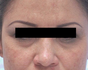 Restylane for eye bags before 199404
