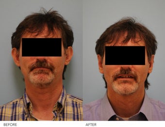 Otoplasty before 240160