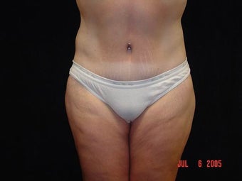 Body Lift with Liposuction of Abdomen, Waist, Flanks after 203460