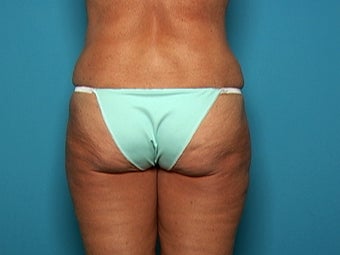 Liposuction after Age 50 after 138881