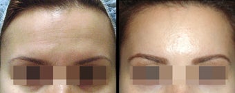 Endoscopic Brow Lift by Wave Plastic Surgery & Dermatology Center before 649395