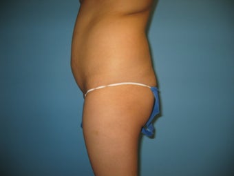 buttock augmentation (Brazilian buttock lift) before 284964