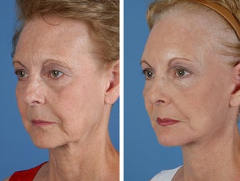 Facelift, Browlift, Upper and Lower Eyelid Surgery after 253952