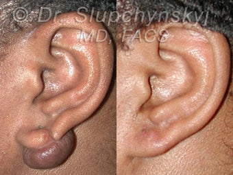 Keloid Removal before 547211