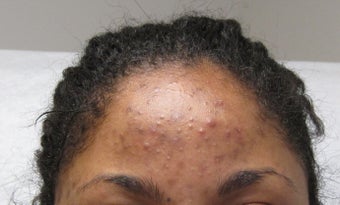 Vi Peel for acne and hyperpigmentation before 298237