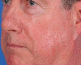 Vbeam laser rosacea treatment after 374582