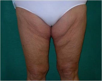 Thigh lift before 589899