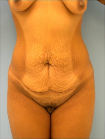 Bikini Tummy Tuck before 241923