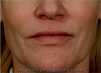 Sculptra, Botox, Juvederm and Restylane after 319352