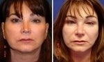 Non Surgical Rhinoplasty before 588458