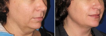 Chin / Neck Liposuction before 342954