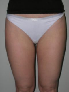 Liposuction after 258650