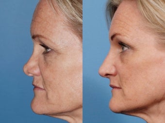 Revision rhinoplasty after 334265