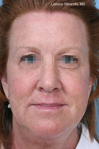 Botox for Forehead, Glabella and Crows Feet after 114165