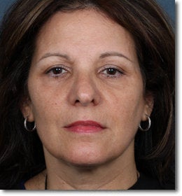 ZPL Peel Light Laser (Weekend Peel) Skin Rejuvenation after 624907