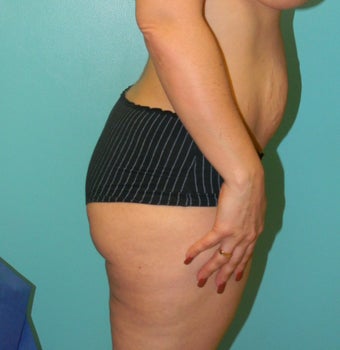 Brazilian Butt Lift- Fat transfer before 372611