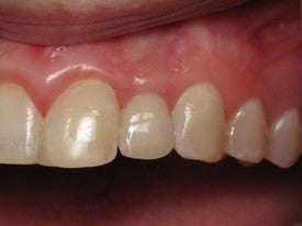 Dental Implant for Missing Lateral Incisor after 504324
