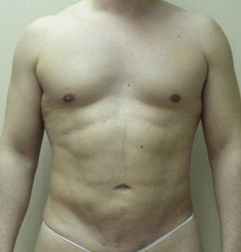 VASER Liposuction (HiDef) after 570288