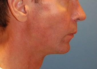 Jaw Augmentation with Mandibular Implants before 166199