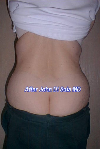Butt Lift Years Following Tummy Tuck after 335551