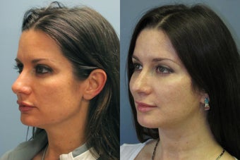 Lite Lift, Brow Lift before 523333