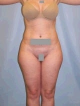 Liposuction Surgery before 139123