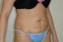 Tummy Tuck before 215070