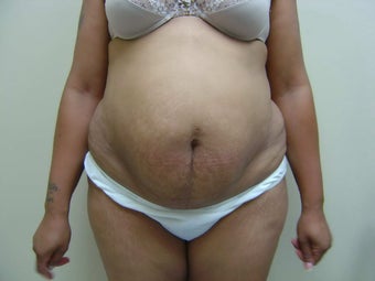 Tummy Tuck before 504649