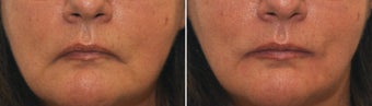 Lower Face Filler before 197402