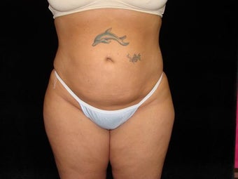 Liposuction of Abdomen, Waist, Flanks and Dorsal Roll after 203473