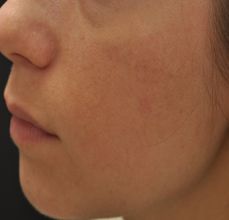 Acne Scarring after 426034