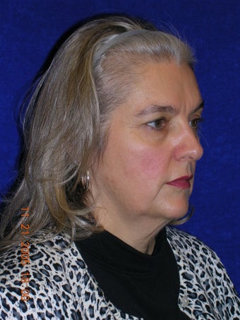 Facelift, Eyelid lift before 466264