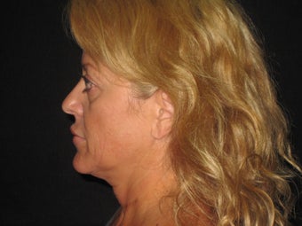 LazerLift before 619233
