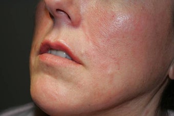 Fillers - Cosmoderm after 136204